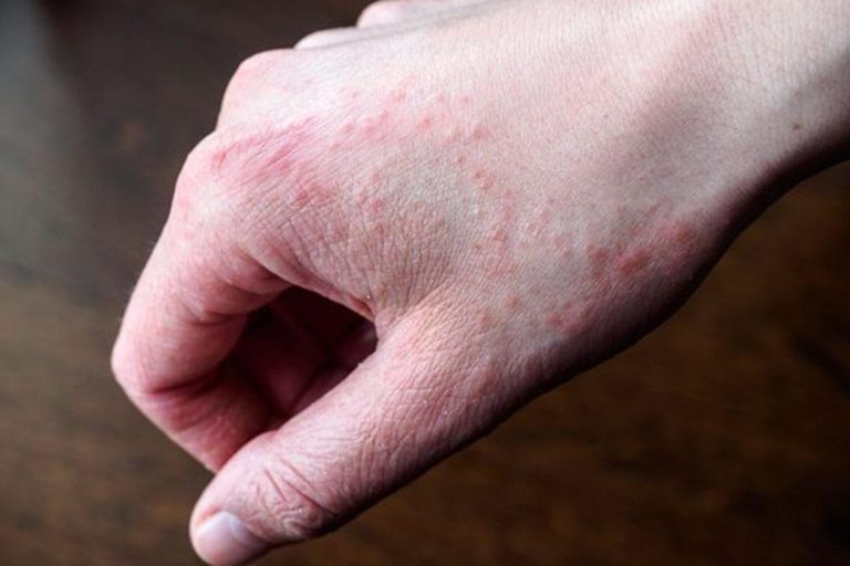 طرق بسيطة تُخلصكِ نهائيًا من مشكلة أكزيما اليد والقدم! طرق بسيطة تُخلصكِ نهائيًا من مشكلة أكزيما اليد والقدم!