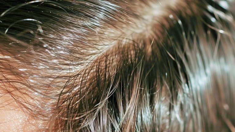 شعري دهني ... ماذا أفعل؟